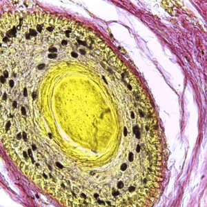 https://dailyalts.com/wp-content/uploads/2020/01/Skin_cancer-wiki.jpg https://dailyalts.com/wp-content/uploads/2020/01/Skin_cancer-wiki.jpg