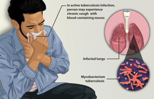 https://dailyalts.com/wp-content/uploads/2021/02/512px-Depiction_of_a_tuberculosis_patient.png https://dailyalts.com/wp-content/uploads/2021/02/512px-Depiction_of_a_tuberculosis_patient.png