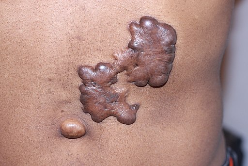 https://dailyalts.com/wp-content/uploads/2021/05/Keloid_Trunk.jpg https://dailyalts.com/wp-content/uploads/2021/05/Keloid_Trunk.jpg