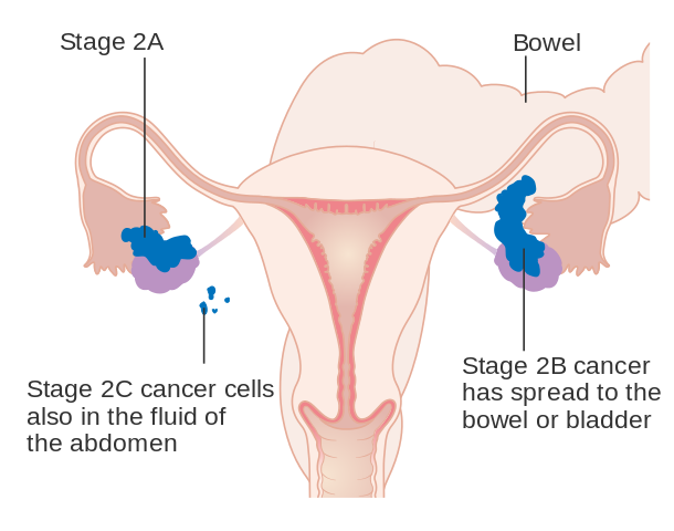 https://dailyalts.com/wp-content/uploads/2021/06/610px-Diagram_showing_stage_2A_to_2C_ovarian_cancer_CRUK_214.svg_.png https://dailyalts.com/wp-content/uploads/2021/06/610px-Diagram_showing_stage_2A_to_2C_ovarian_cancer_CRUK_214.svg_.png